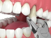 Tooth Extraction (removal) Procedures