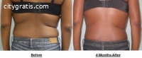 Cool Body Sculpting Before And After