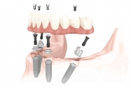 Dental Implant Center San Diego