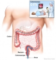 Laparoscopic Colorectal Surgery