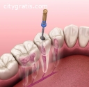 Root Canal Columbia MO