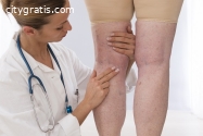 What is the Treatment for Varicose Veins